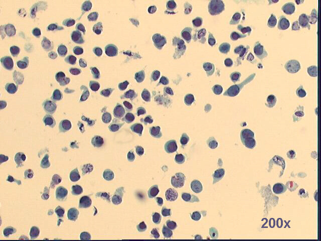 Decoy cells, Pap staining, low power view shows many abnormal looking tubular cells, with very dense nuclei and/or degenerated nuclei