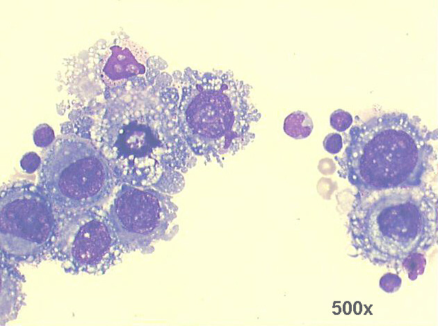 500x M-G-G staining, high power view of previous image