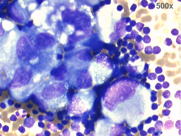 500x M-G-G staining, a group of large round malignant cells, notice the eccentric nuclei