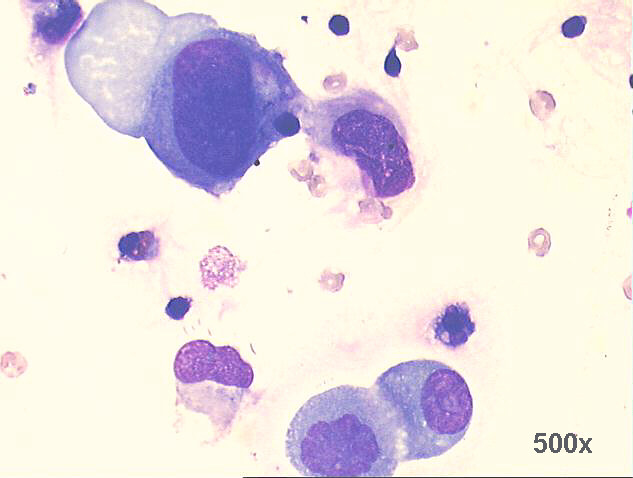 500x M-G-G staining, large isolated round malignant cells