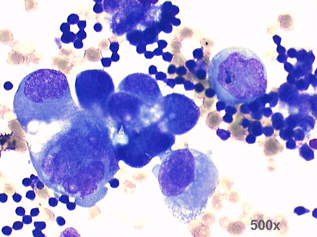 500x M-G-G staining, one group of malignant cells and some large isolated round malignant cells
