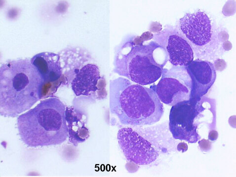 Urothelial carcinoma in situ 500x M-G-G staining, isolated malignant cells