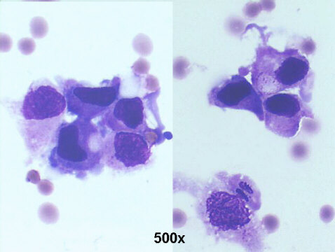 Urothelial carcinoma in situ 500x M-G-G staining, isolated malignant cells