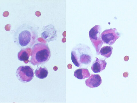 Urothelial carcinoma in situ 500x Pap staining, isolated malignant cells