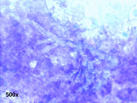 Invasive Aspergillosis, 500x M-G-G, faintly stained hyphae