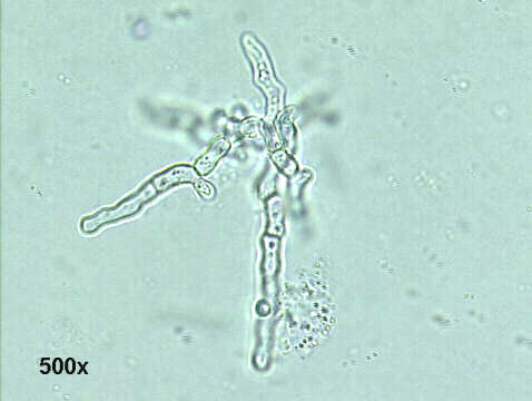 Invasive Aspergillosis, 500x KOH direct smear, hyaline septate hyphae