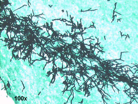 Invasive Aspergillosis, 100x Gomori, large number of hyphae