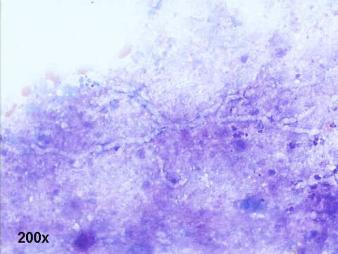 Invasive Aspergillosis, 200x M-G-G staining, faintly stained dychotomous branching hyphae