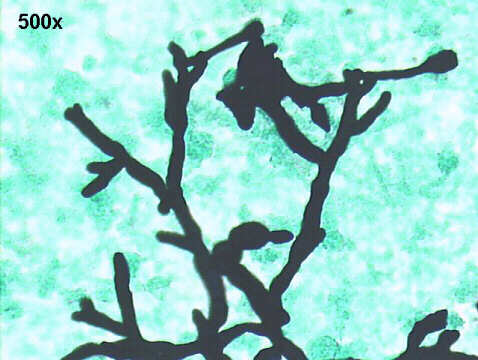 Invasive Aspergillosis, 500x Gomori, 45 degree dychotomous branching large hyphae