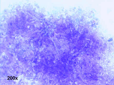 Invasive Aspergillosis, 200x M-G-G staining, faintly stained hyphae 