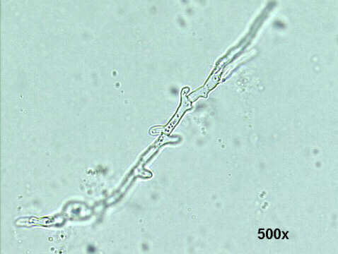 500x KOH direct smear, hyaline septate hyphae
