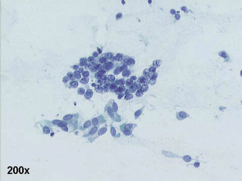 200x Pap staining, loose group of small round cells