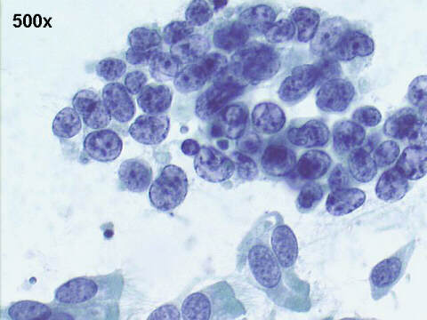 500x Pap staining, same field as previous picture: notice small amount of cytoplasm, irregular chromatin