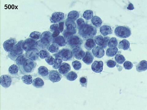 500x Pap staining, notice small amount of cytoplasm, irregular chromatin, nuclear molding