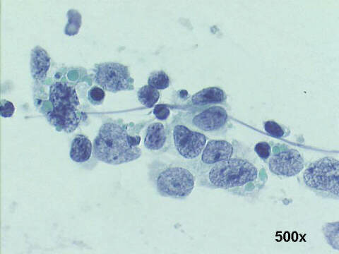 500x Pap staining, notice the dark blue apoptotic bodies, and the salt and pepper chromatin