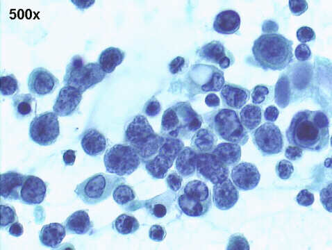 500x Papanicolaou staining, ascites