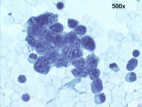 500x Papanicolaou staining, undifferentiated malignant neoplasia pattern 