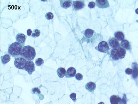 500x Papanicolau staining, undifferentiated malignant neoplasia pattern
