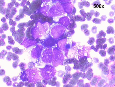 500x M-G-G staining, undifferentiated malignant neoplasia pattern, many cytoplasmic small vacuoles