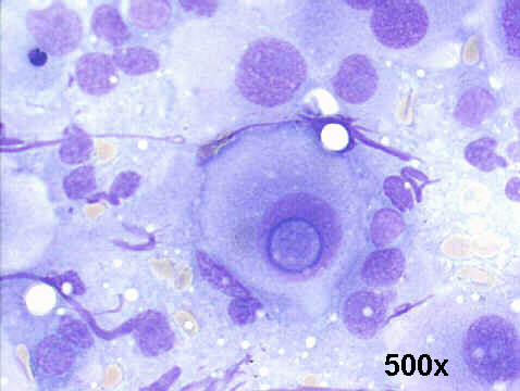 500x M-G-G staining, FNA groin mass