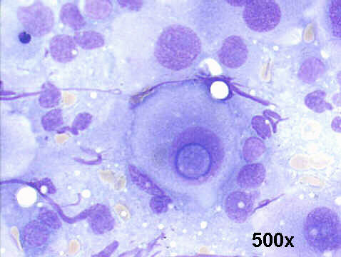 500x M-G-G staining, prominent intranuclear vacuoles