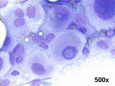 500x M-G-G staining, FNA groin mass