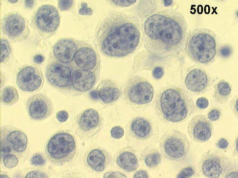 500x Papanicolaou staining, many malignant cells with variable size and amount of cytoplasm