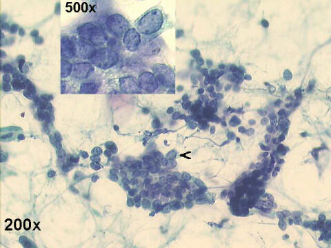  200x with 500x inset, Papanicolaou staining