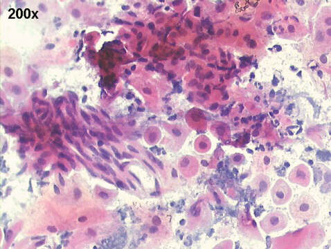 Papanicolaou staining, some small hyperkeratotic cells are present