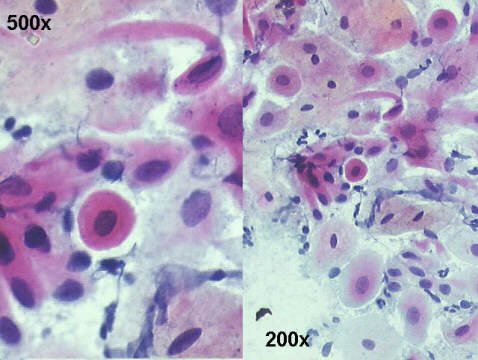 Papanicolaou staining, there is one cell with a bizarre shape but with a nucleus with normal looking chromatin.
