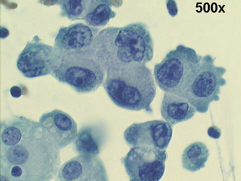 500x Papanicolaou staining, loose loose group of malignant looking mesothelial cells
