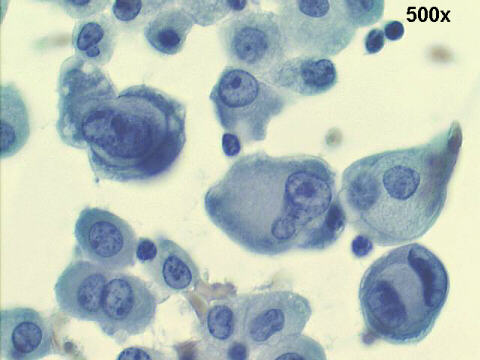 500x M-G-G staining, nuclear enlargement, some gaps between malignant cells, cell claspings