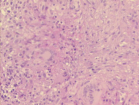 200x H&E staining, granulomatous pleuritis with Langhans histiocyte