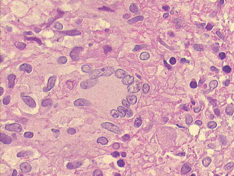 500x H&E staining, detail of Langhans multinucleated histiocyte