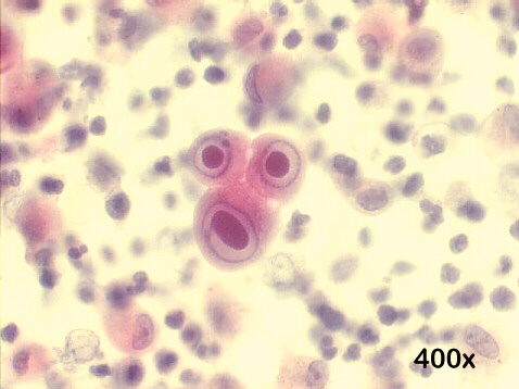 Cytomegalovirus Pap staining, owls eye cells