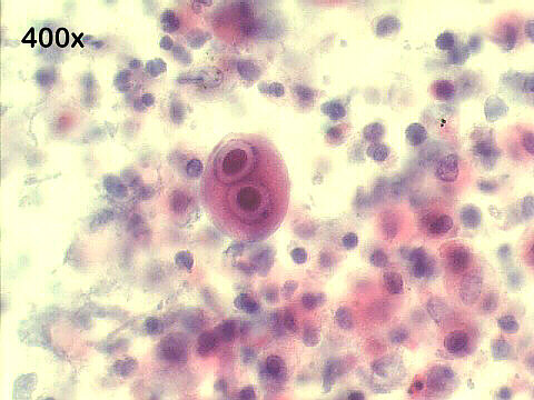 Cytomegalovirus Pap staining, owls eye binuclated cell