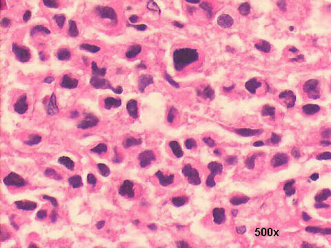 Anaplastic cells H&E 500x