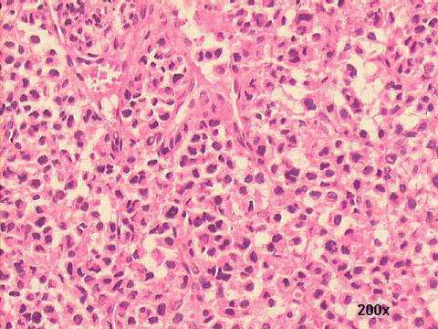 Anaplastic cells H&E 200x