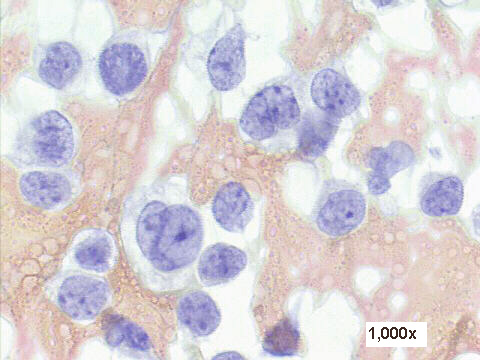 Papanicolaou staining, 1,000x AML blast cells, see the clefts and grooves in several nuclei