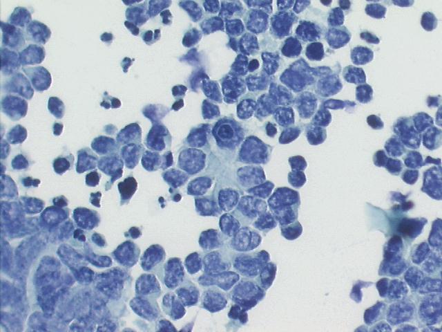 Metastatic  retinoblastoma, single small cells, with numerous loose groups showing nuclear molding with salt and pepper chromatin, small or absent nucleoli; a pseudo-rosette. 200x Pap staining