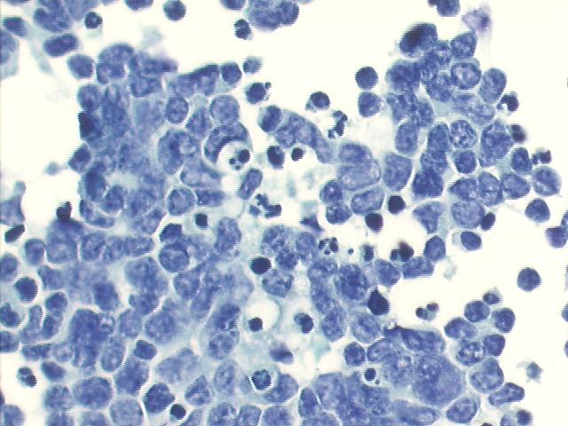 Metastatic  retinoblastoma, single small cells, with numerous loose groups showing nuclear molding. The nuclei are oval or angulated, many apoptotic bodies, 200x Pap staining