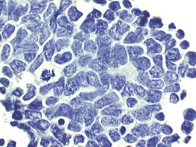 Metastatic  retinoblastoma, notice another pseudo-rosette, 500x Pap staining
