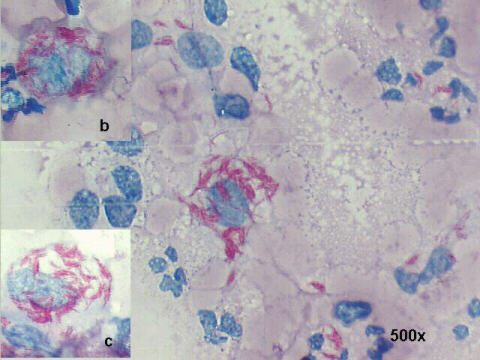 Ziehl-Neelsen staining, the rod-shaped bacteria are positively stained