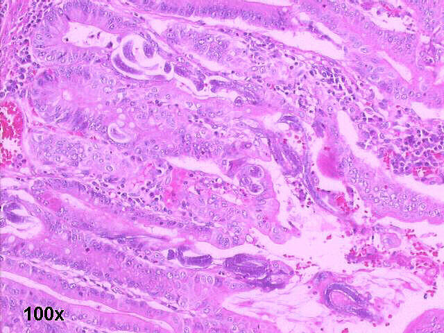 Photo 4 Small bowel resection specimen histology, H&E staining 100x