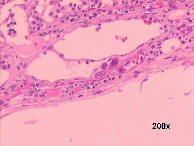 Photo 1 Lymph node histology H&E 200x