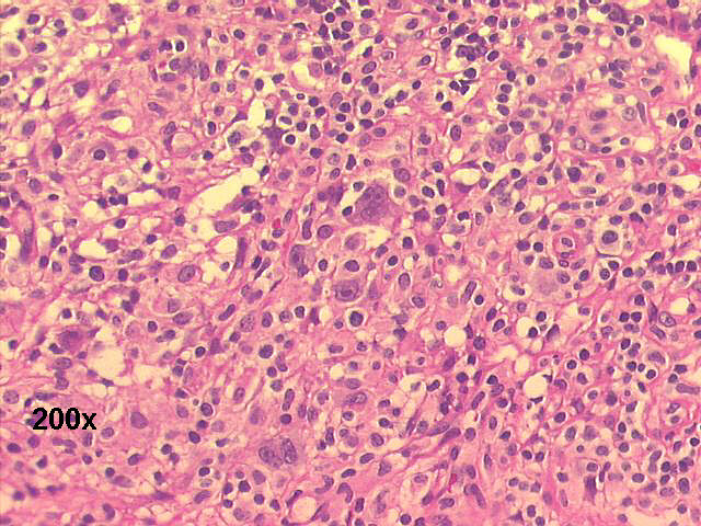 Hodgkin�s lymphoma 200x H&E staining 
