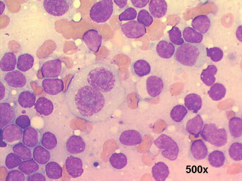 FNA left cervical mass, Reed-Sternberg cell 500x M-G-G 