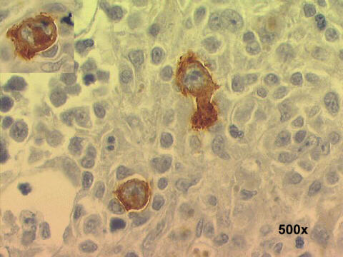 Cells CD30 positive 500x