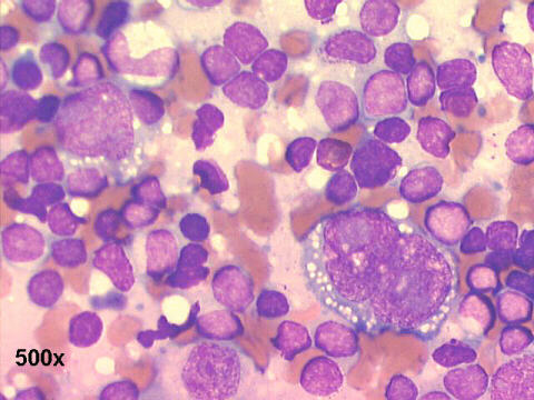 FNA left cervical mass, Hodgkin's cell (left) - Reed-Sternberg cell (right) 500x M-G-G 