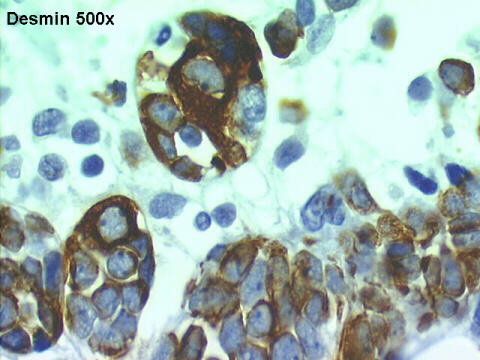 500x Desmin positive  staining